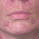 Illustration for article titled On iDr. Pimple Popper/i, the Bumps Run in the Family